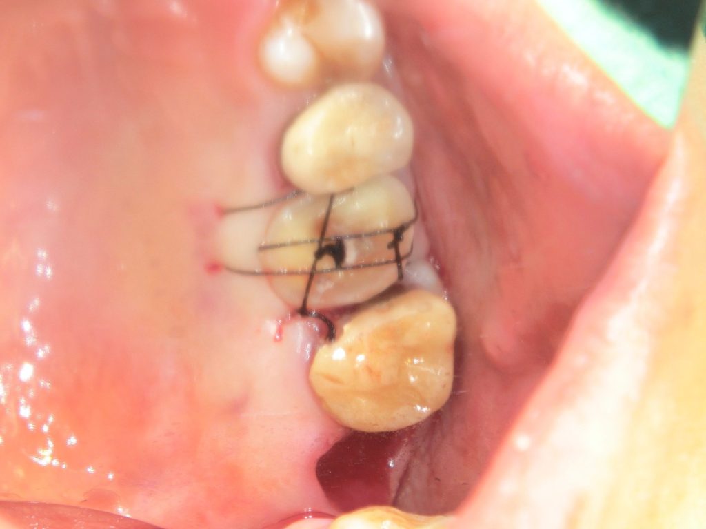 自家歯牙移植 | 診療案内 | なかむら歯科医院